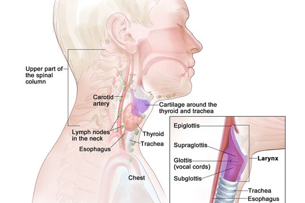 Types of Laryngeal Cancer