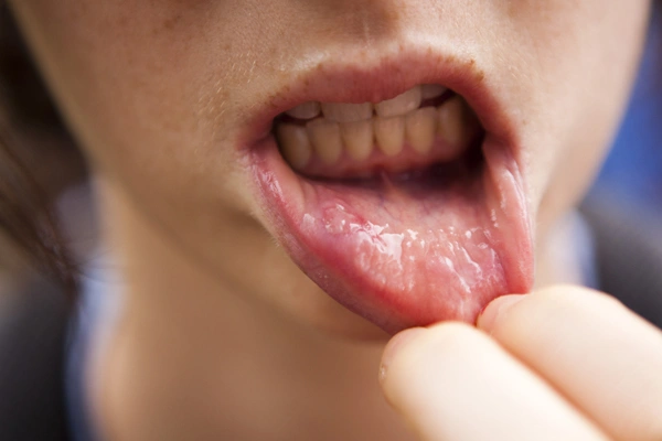 Causes & Risk Factors of Lip Cancer