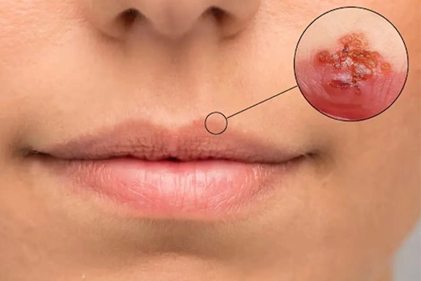 Symptoms of Lip Cancer