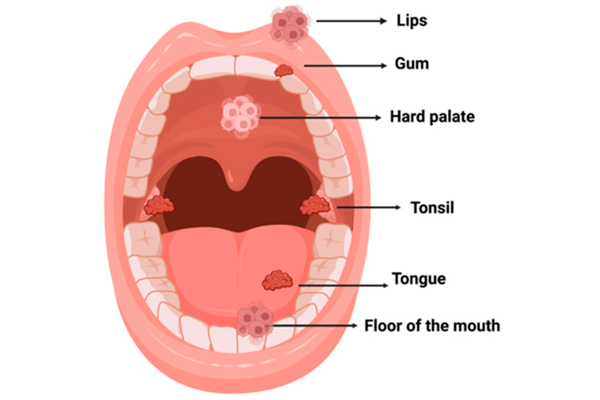 Types of Oral Cancer