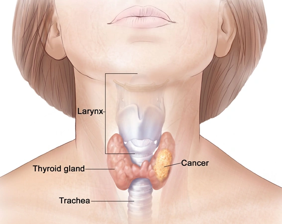 Function Preservation in Pharyngeal Cancer Treatment