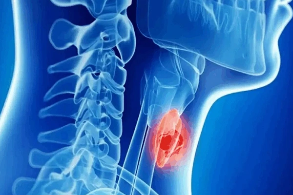 Outcomes & Survival in Pharyngeal Cancer