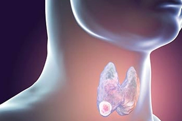 Causes & Risk Factors of Throat Cancer