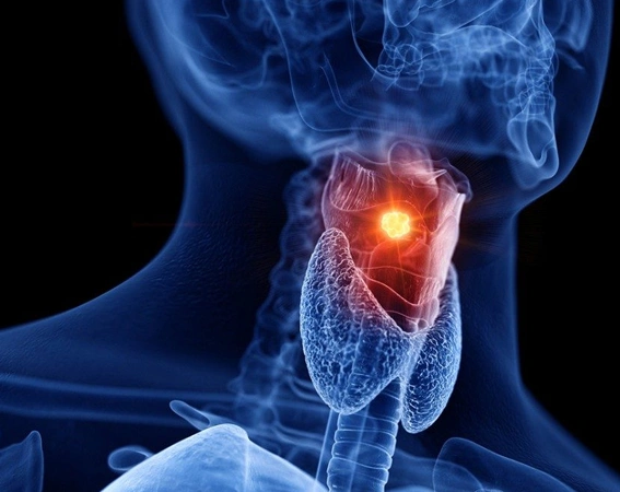 Function Preservation in Throat Cancer Treatment