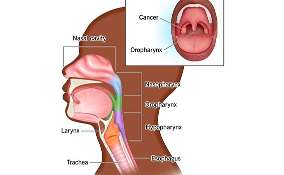 What is Throat Cancer