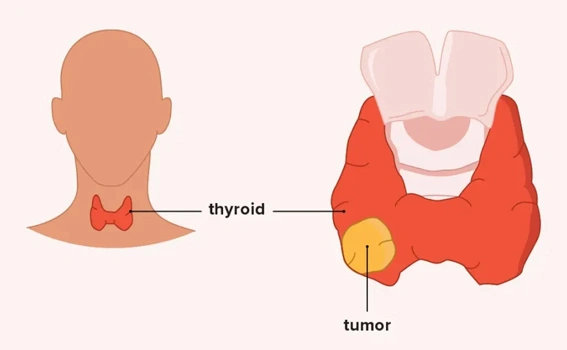 Thyroid Cancer Diagnosis
