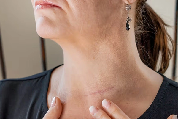 Recovery Timeline After Thyroid Surgery
