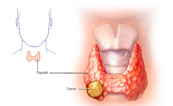 What is Thyroid Cancer
